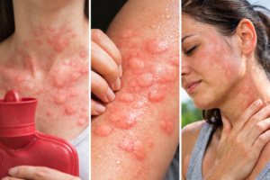 Wärmeurtikaria verständlich erklärt